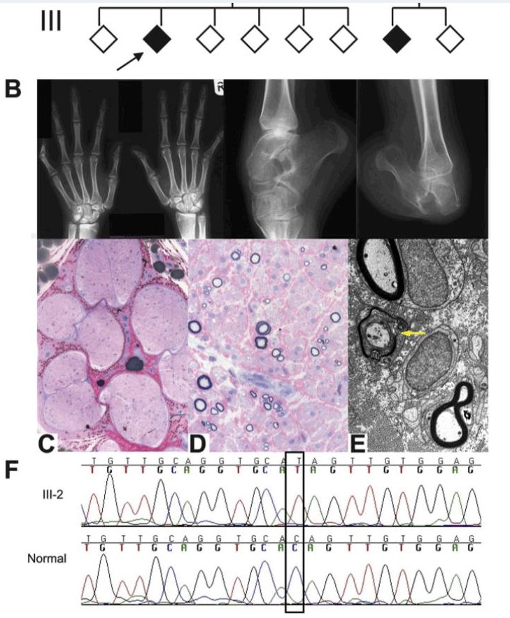 Mutation in FAM134B causing severe hereditary sensory neuropathy: Figure 1