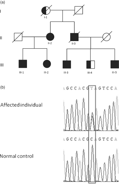 A novel p.Glu175X premature stop mutation in the C terminal end of HSP27 is a cause of CMT2